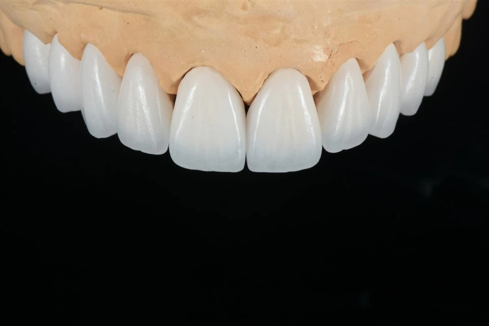 Veneer Feldspathic cho các trường hợp chỉnh hình nụ cười
