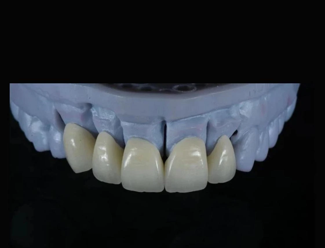 Aesthetic and Strong Zirconia Crown Aesthetic and Strong Zirconia Crown
