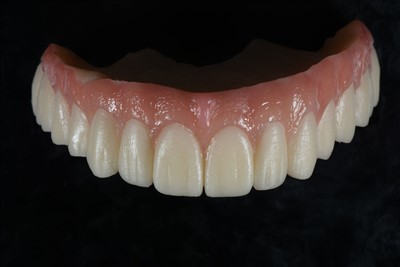 Vương miện tạm thời bằng nhựa acrylic