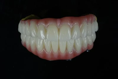 Tất cả-trên-Cầu răng X Zirconia có nướu hồng