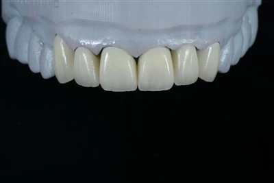Veneer phân lớp E.max mặt trước