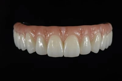Được thiết kế kỹ thuật số Tất cả{0}}trên-X Zirconia Bridge