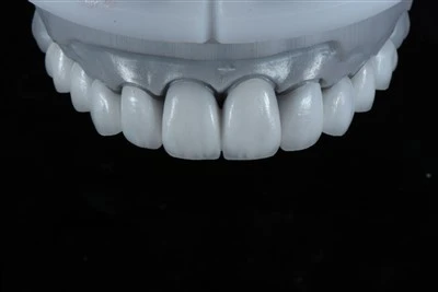 Veneer phân lớp E.max được thiết kế kỹ thuật số