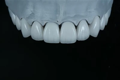 Veneers phân lớp E.max để chỉnh sửa hình dạng răng