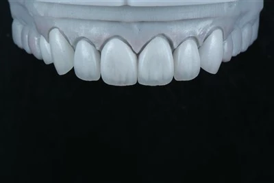 Veneers phân lớp E.max với kết cấu bề mặt
