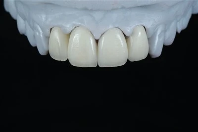 Bốn-Miếng dán phân lớp E.max phía trước hàm trên