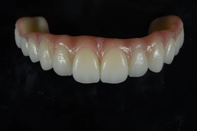 -Cầu răng Zirconia đầy đủ với đặc điểm nướu