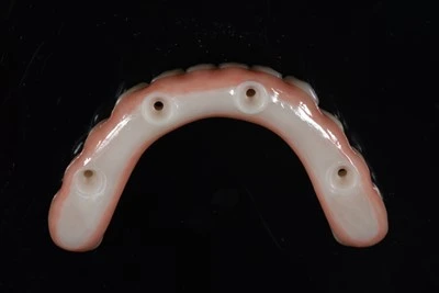 -Cầu cấy ghép toàn bộ bằng Zirconia