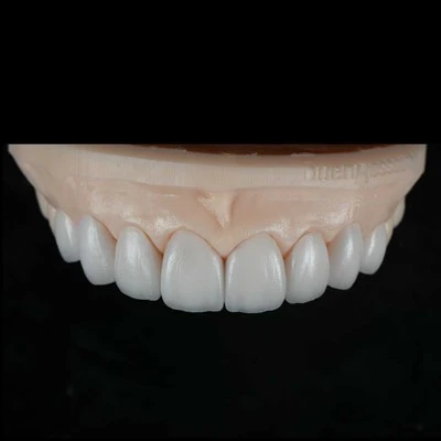 Veneer Thẩm Mỹ Tự Nhiên Mạnh Mẽ Và Chính Xác