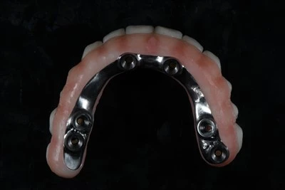 Vít-Giữ lại tất cả-trên-Cầu X Zirconia