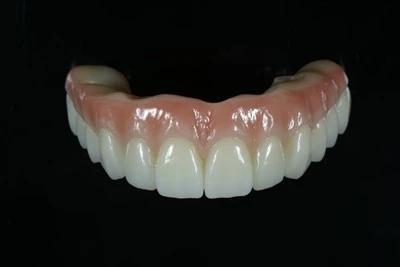 Titan-Được gia cố toàn bộ-trên-Cầu X Zirconia