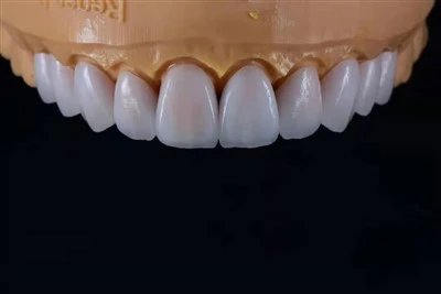 Veneer phân lớp E.max siêu mỏng